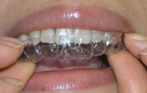 Clearpath aligners
