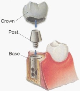 Dental Implant