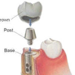 Dental Implant in Delhi