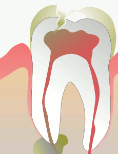 enamel absorption and tooth sensitivity