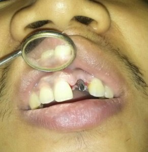 Dental Implant Placed