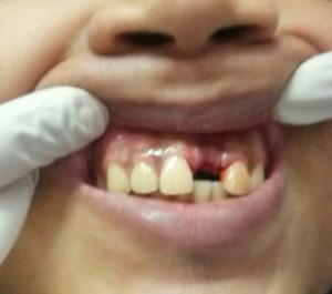 Before Dental Implant