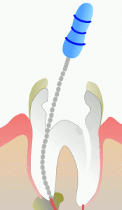 Root Canal Treatment Surgery