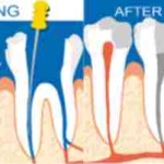 root canal treatment city dental