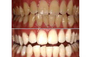 teeth whitening cost