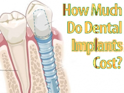 Cost of dental implant in Delhi