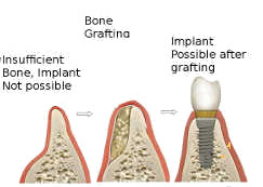 tooth bone grafting explained