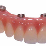 Implant supported Denture