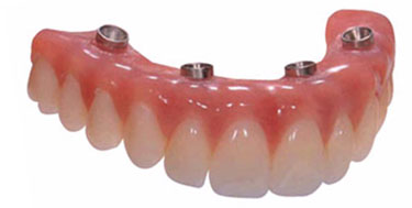 All on four implant denture in delhi