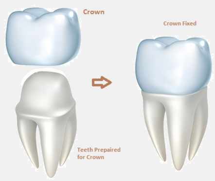 Dental crown, tooth cap
